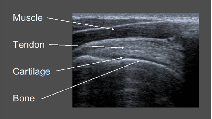 Musculoskeletal (MSK) Ultrasound image