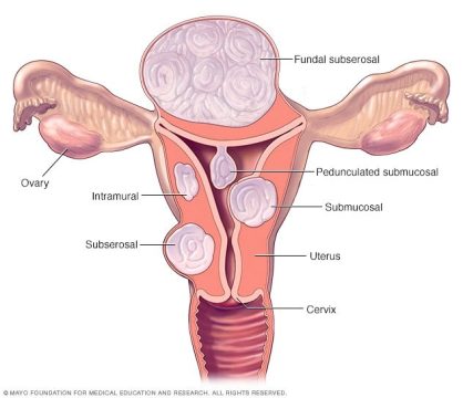 fibroids-1