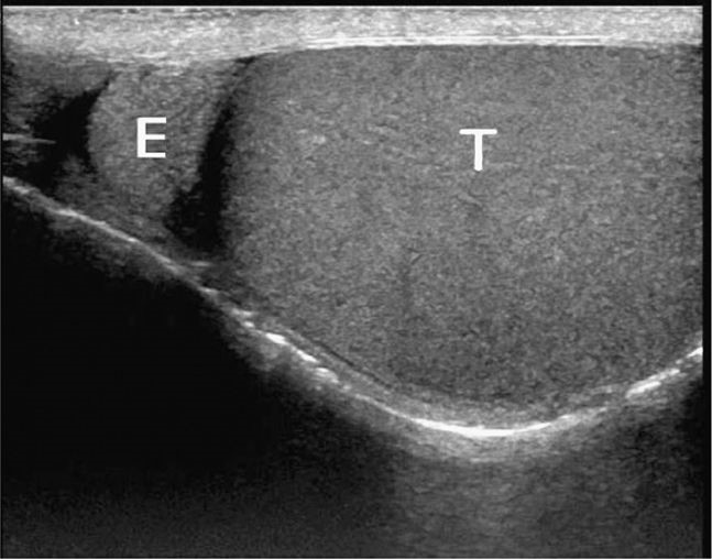 Ultrasound of the testes or scrotum; Ultrasound images of a normal testes