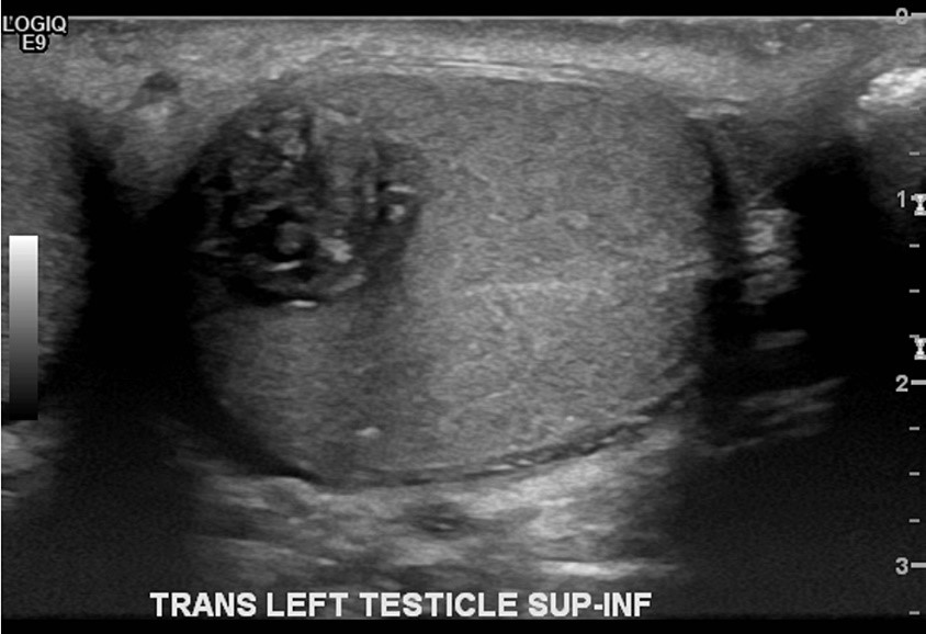Ultrasound of the testes or scrotum. Left Testicle